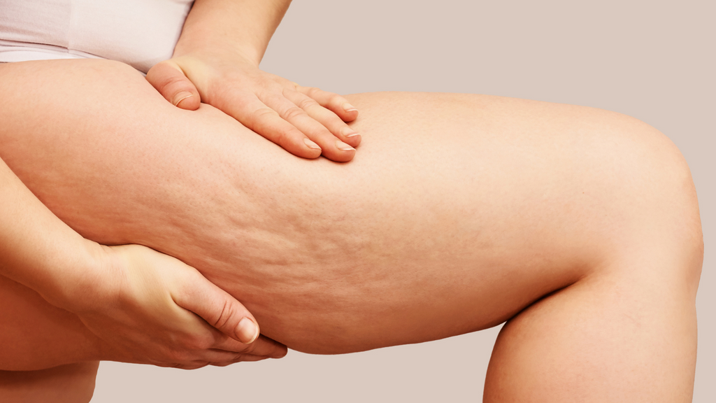 Cellulite: cos'è e cosa fare parte 1